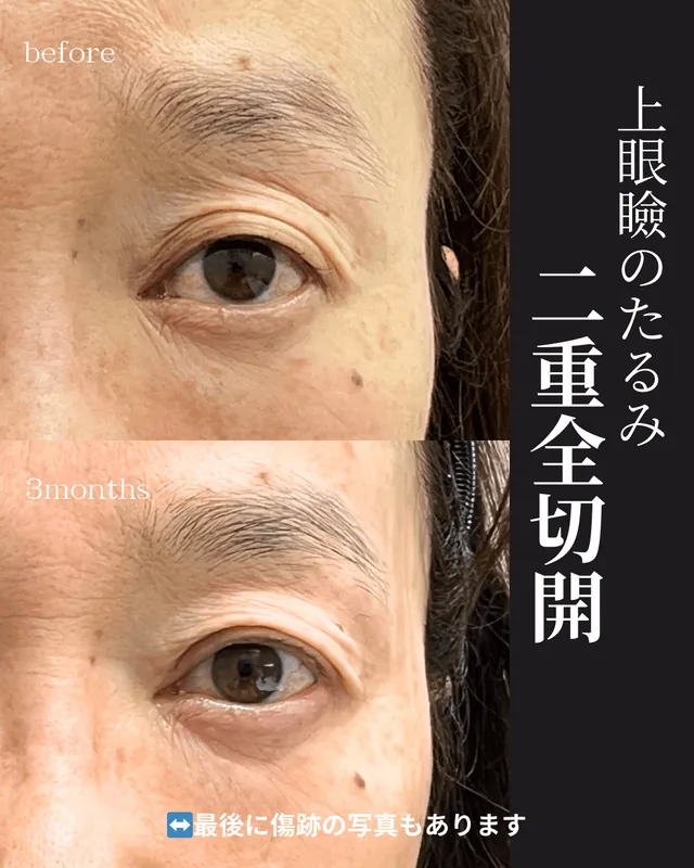 二重全切開