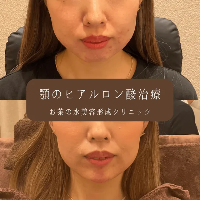 顎ヒアルロン酸注入