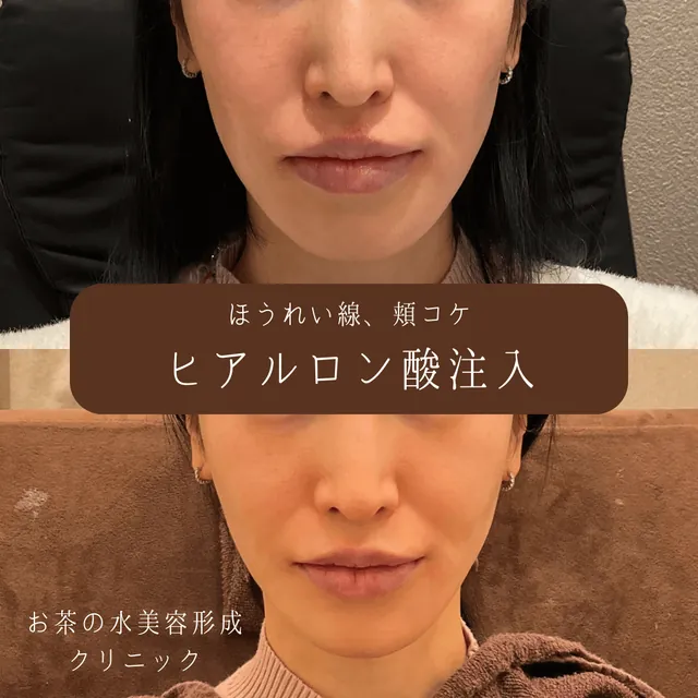 ヒアルロン酸注入（ほうれい線・頬こけ）