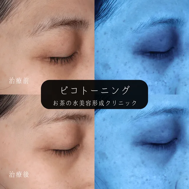 ピコトーニング（目周りの色素沈着）