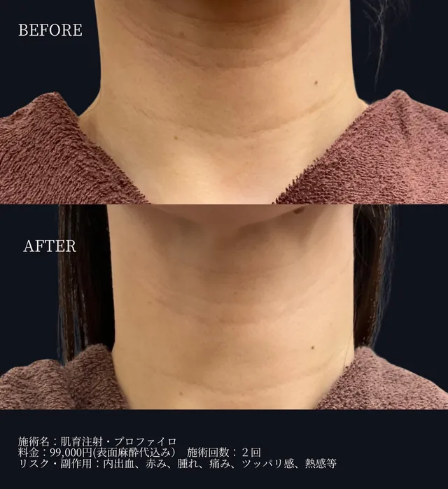 プロファイロ（首）