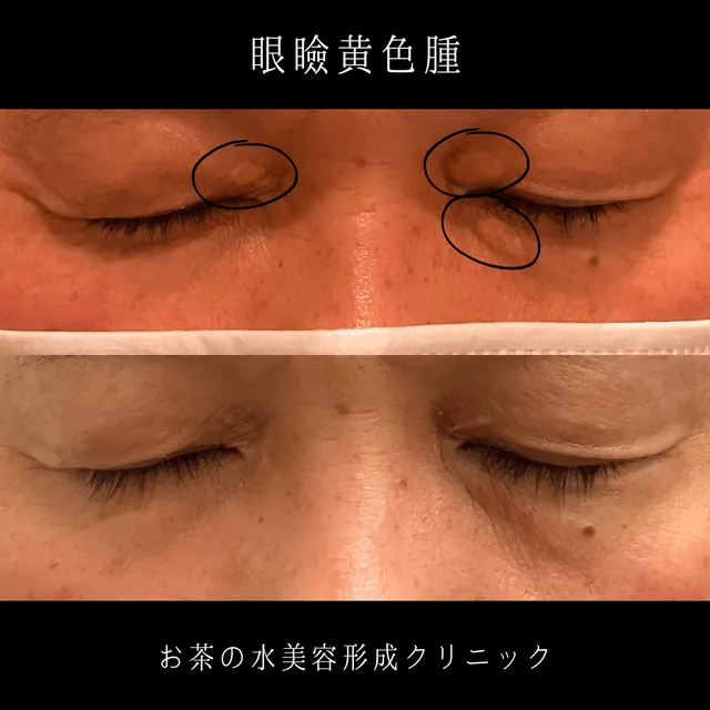 眼瞼黄色腫の治療