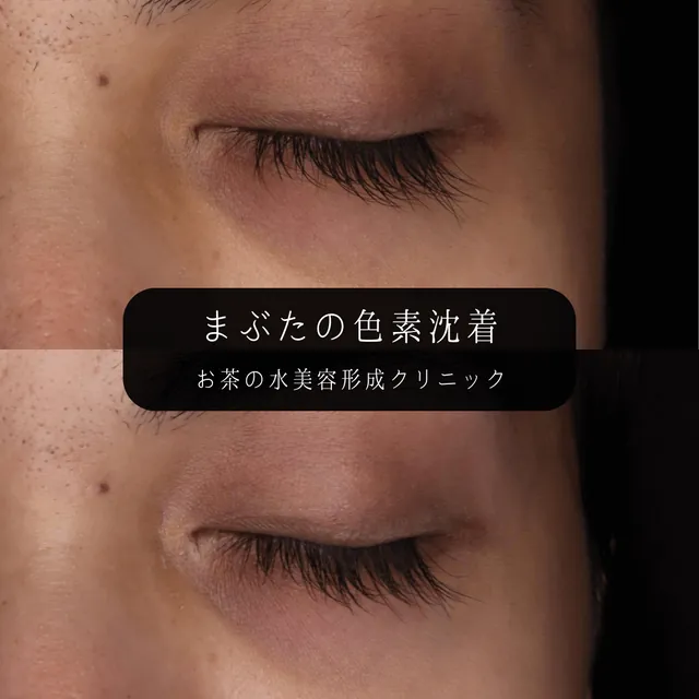 まぶたの色素沈着の治療