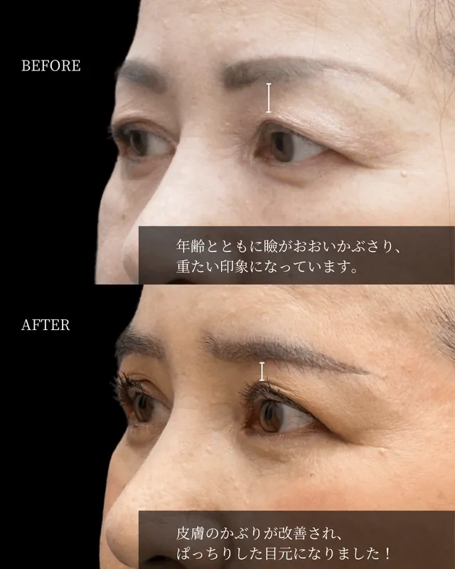 眉下切開