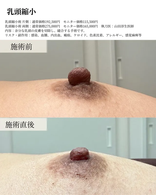 乳頭縮小