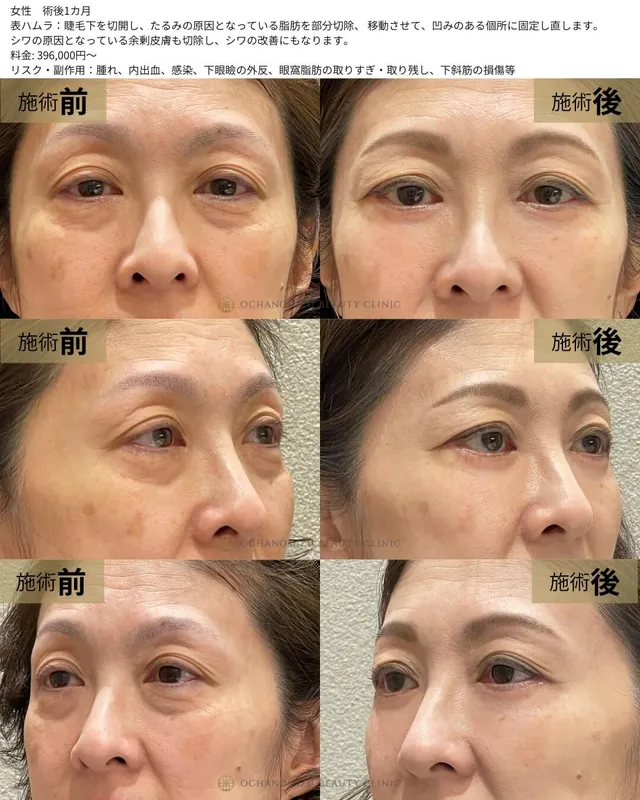 表ハムラ