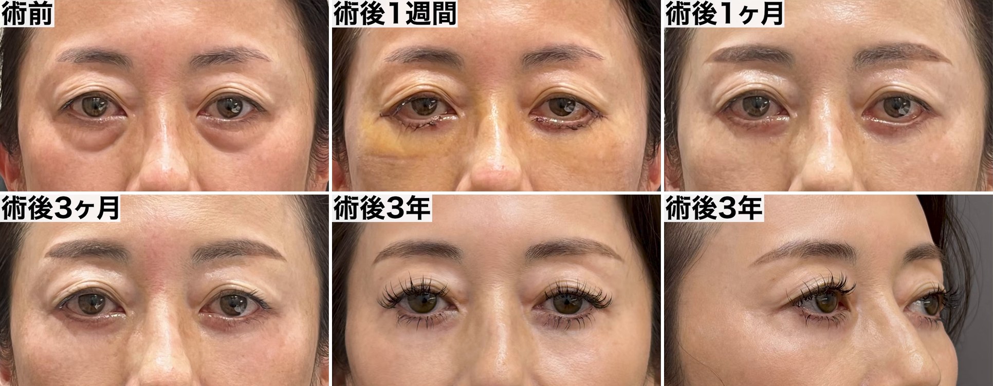 表ハムラ法の症例 術前・術後1週間・術後1ヶ月・術後3ヶ月・術後3年(正面・斜め)