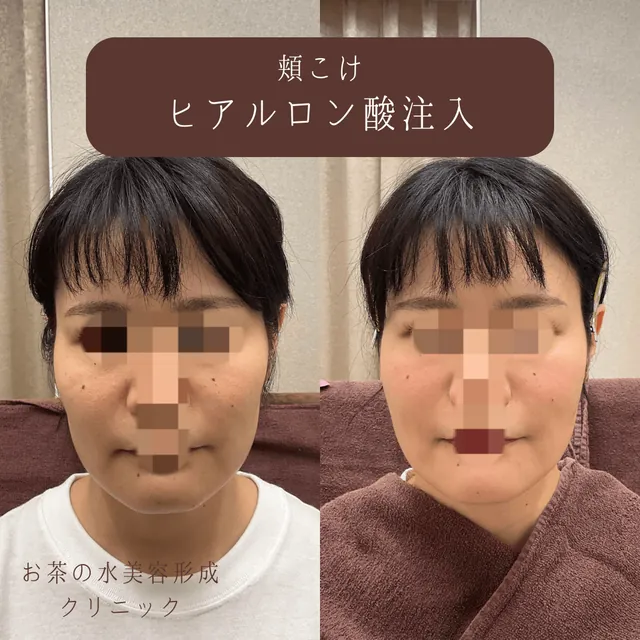 頬こけヒアルロン酸注入