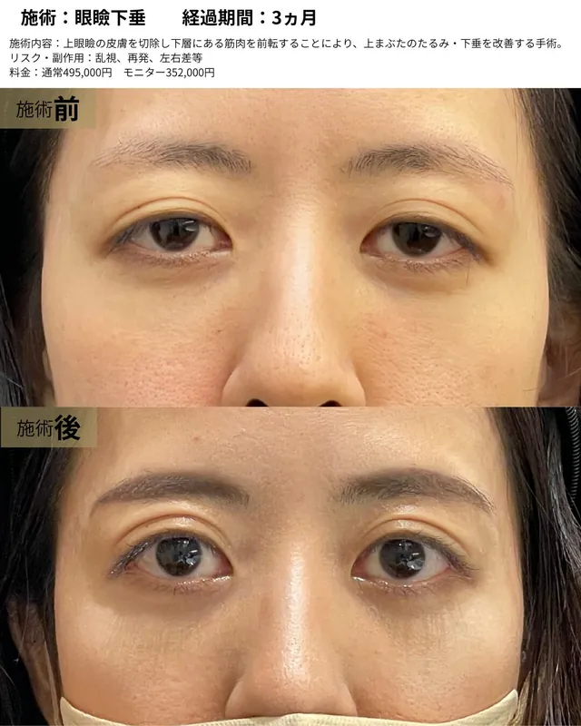 眼瞼下垂