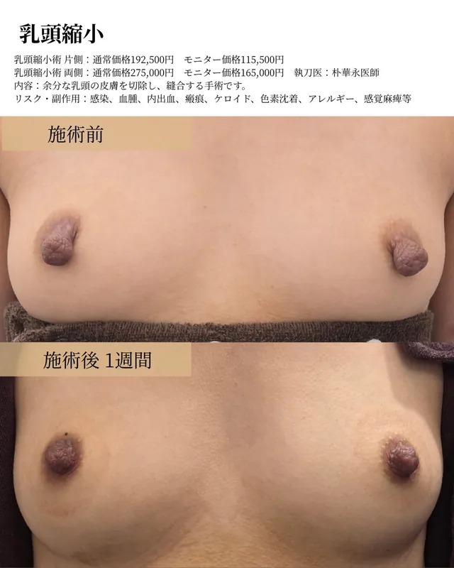 乳頭縮小