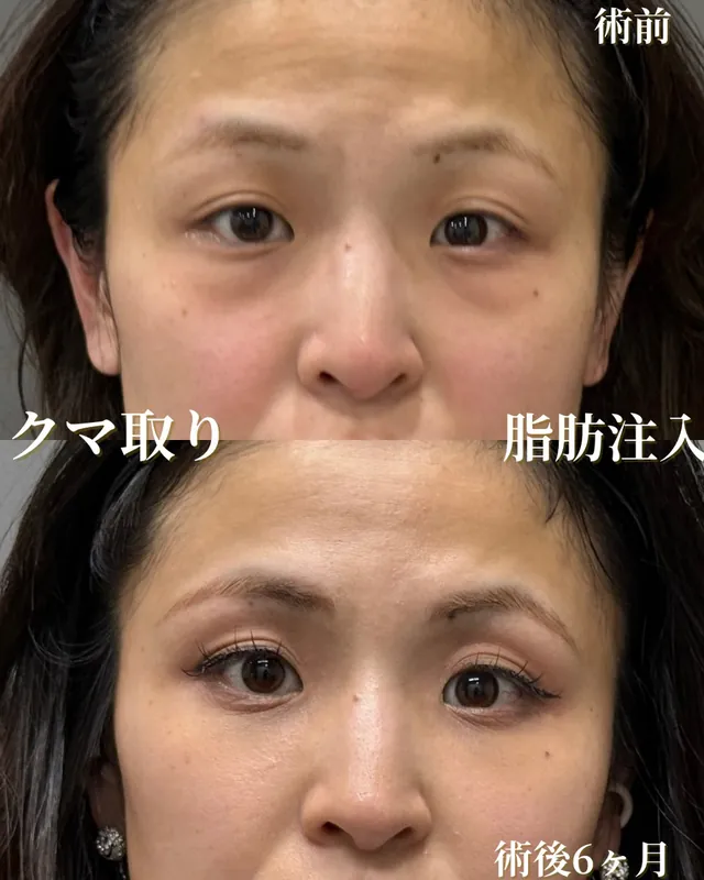 クマ取り＆脂肪注入