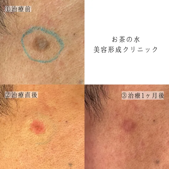脂漏性角化症の治療