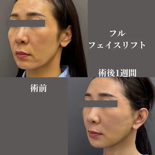 フルフェイスリフト