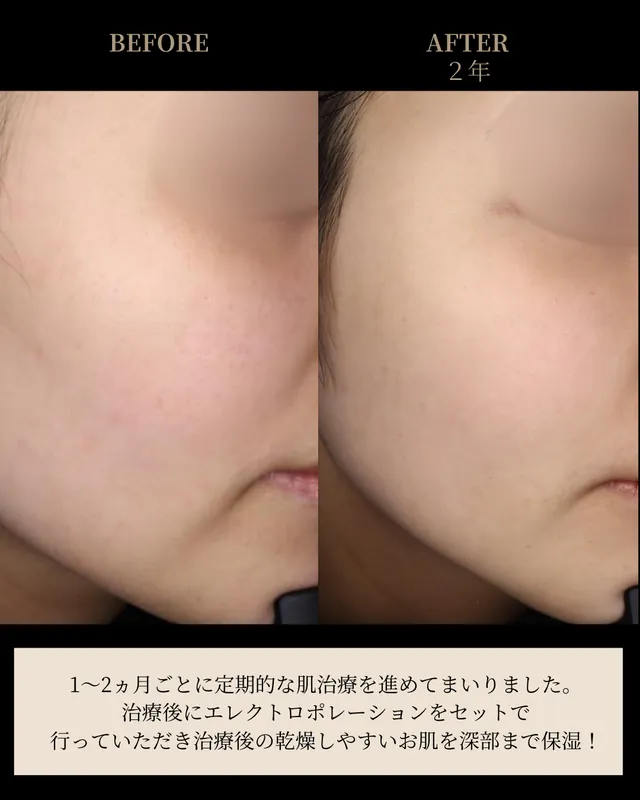 肌治療（2年間の継続治療）