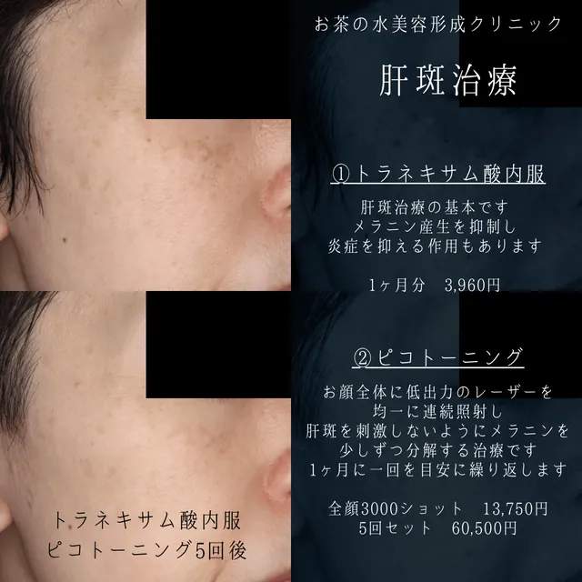 肝斑治療
