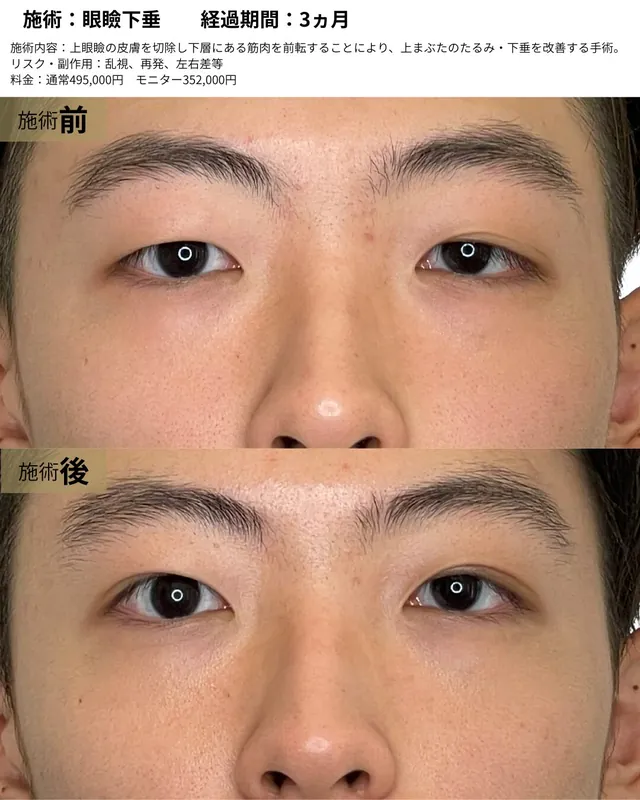 眼瞼下垂