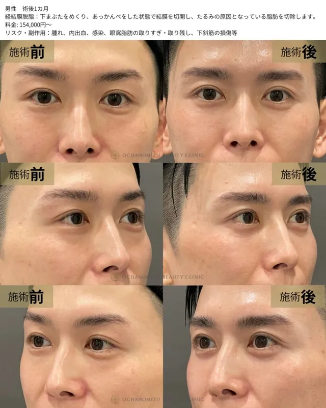 経結膜脱脂