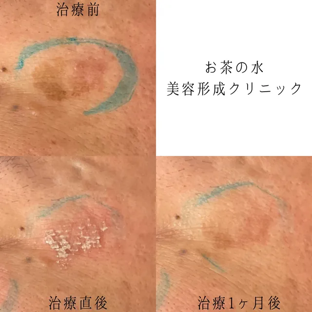 ピコスポット