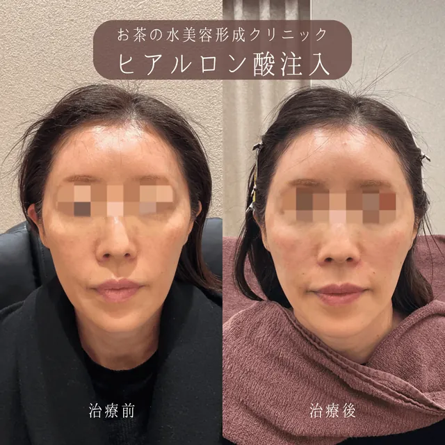 ヒアルロン酸注入（顔全体）