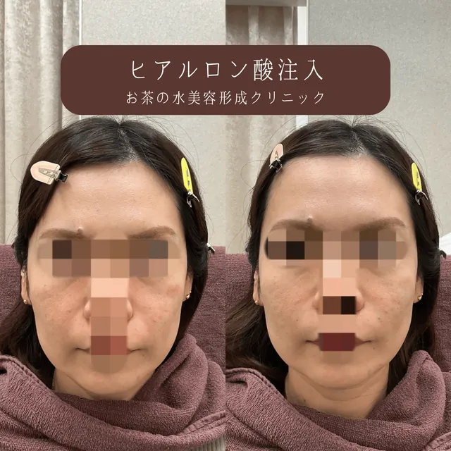 ヒアルロン酸注入（頬・ゴルゴライン・ほうれい線）