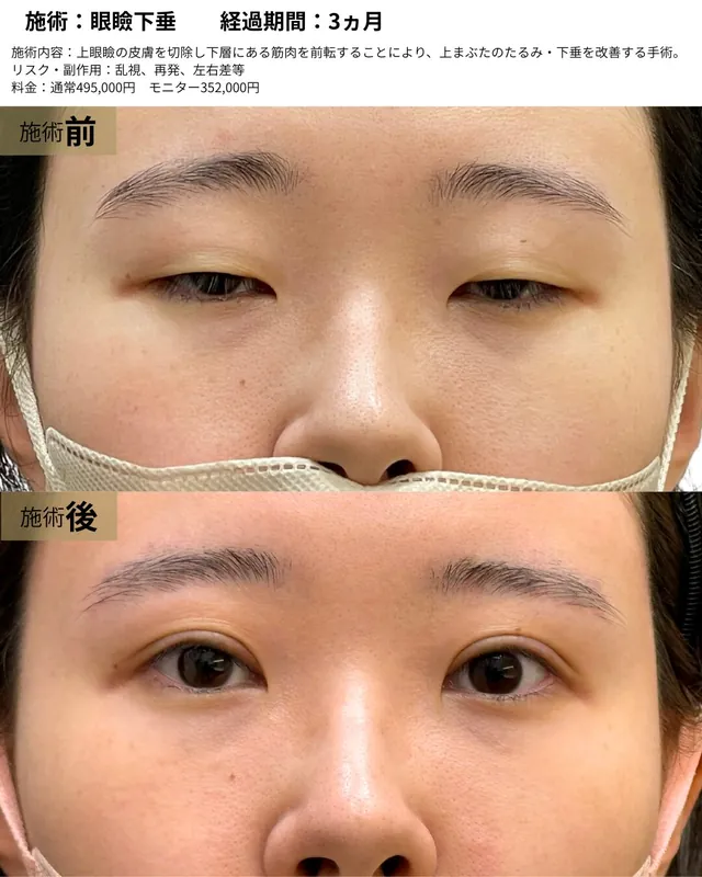 眼瞼下垂