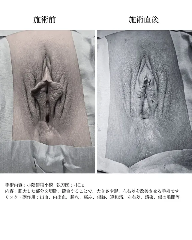 小陰唇縮小術