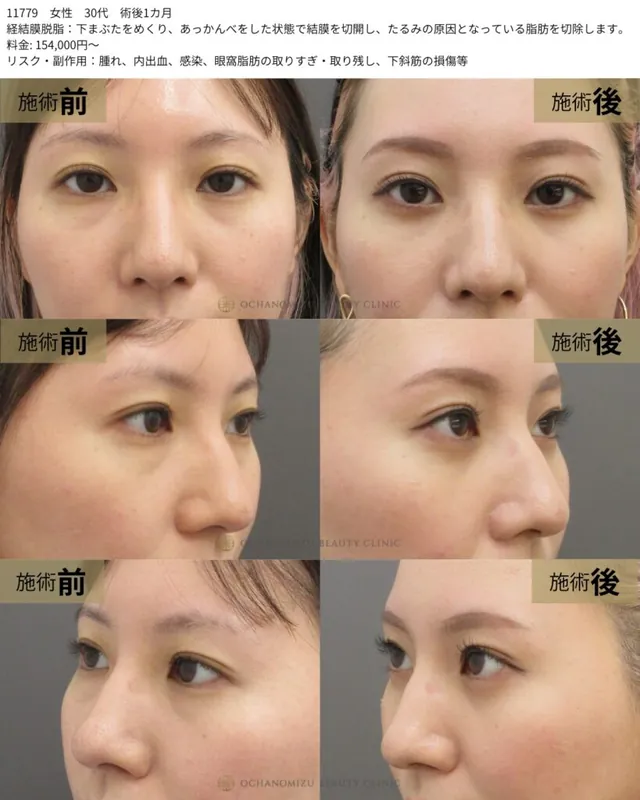 経結膜脱脂