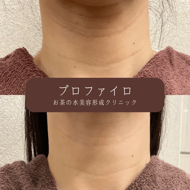 プロファイロ（首）