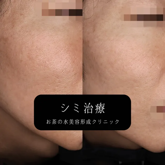 ピコトーニング