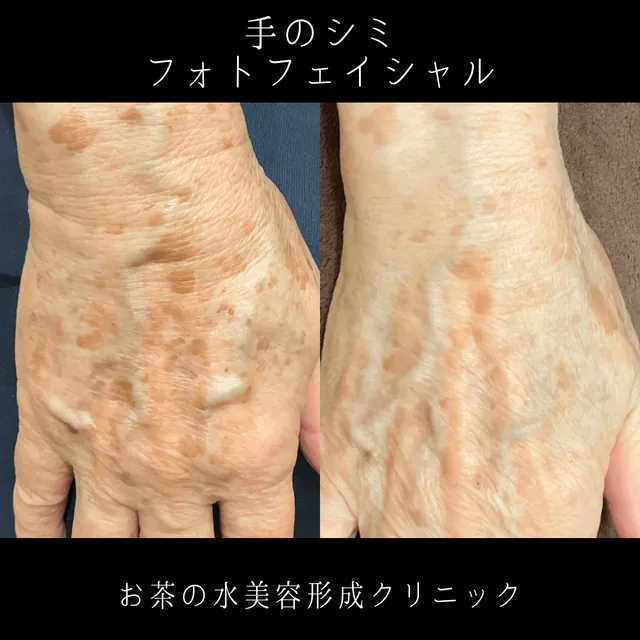 フォトフェイシャル（手のシミ）