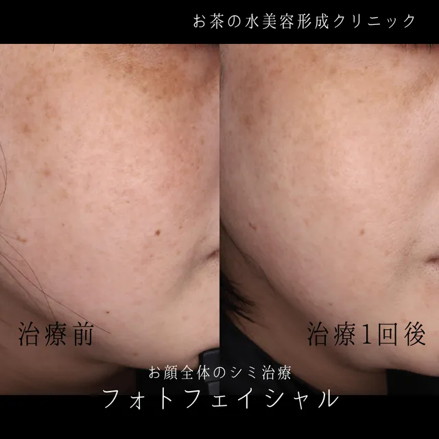 フォトフェイシャル
