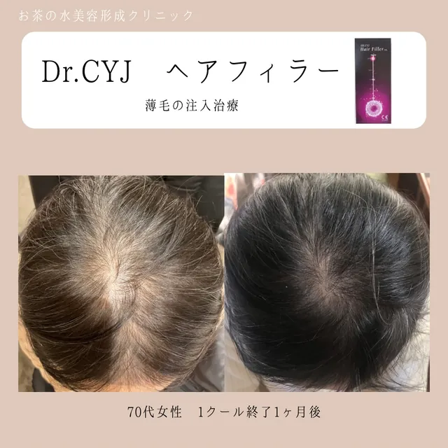 毛髪注入（ヘアフィラー）
