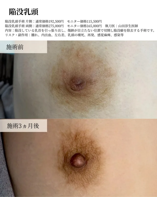 陥没乳頭