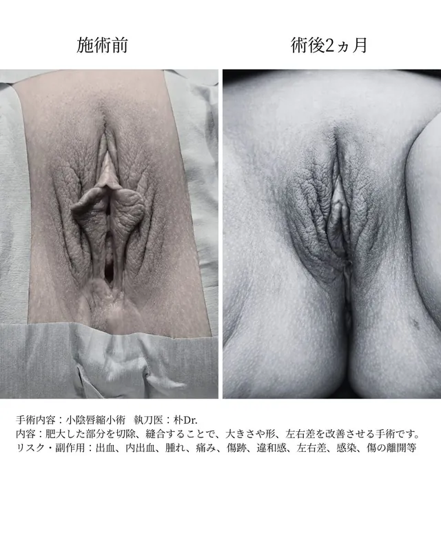 小陰唇縮小術