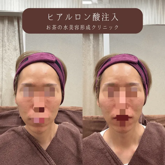 ヒアルロン酸注入
