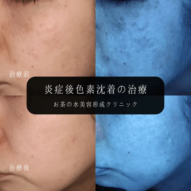 炎症後色素沈着の治療