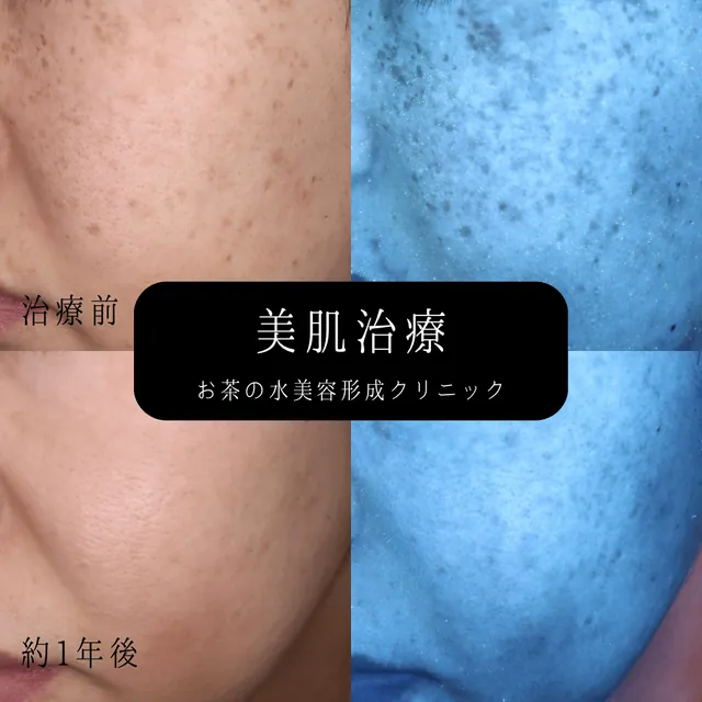 美肌治療