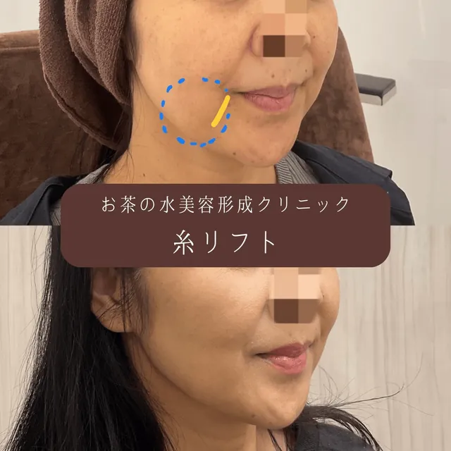 糸リフト