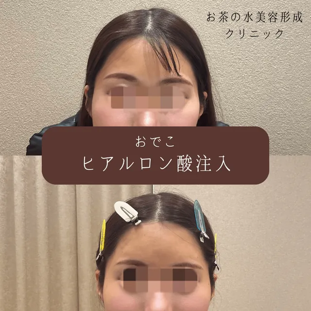 おでこ・こめかみヒアルロン酸注入