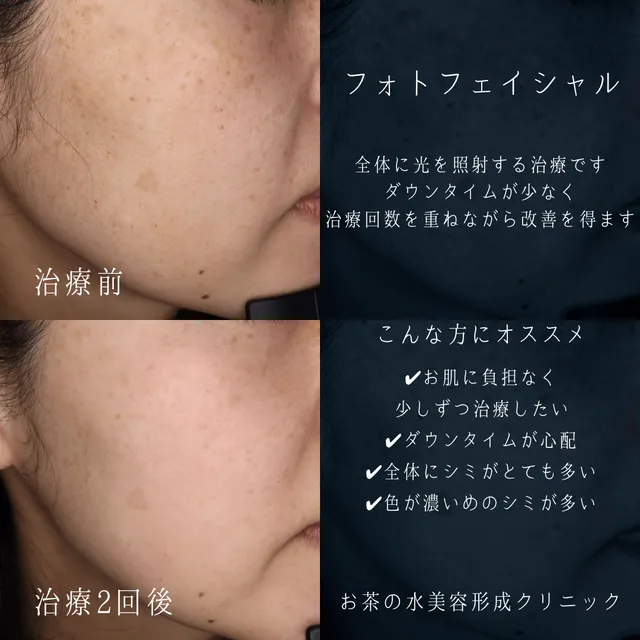 フォトフェイシャル