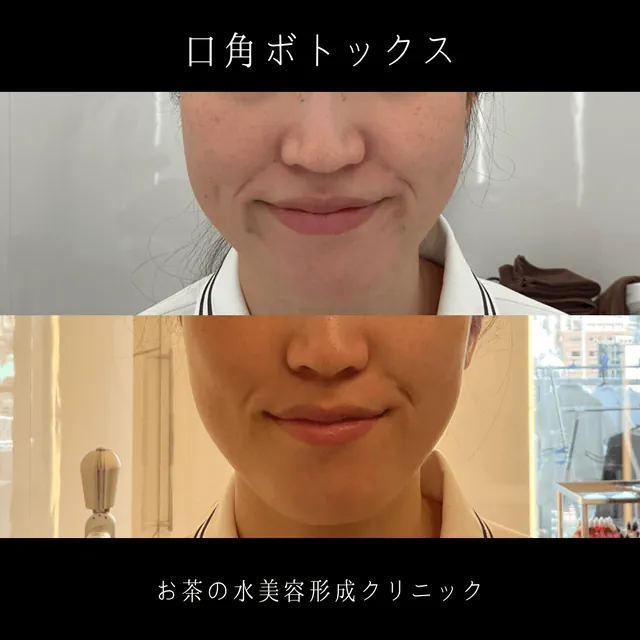 口角ボトックス