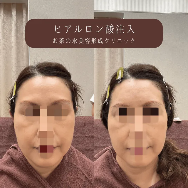 おでこヒアルロン酸注入