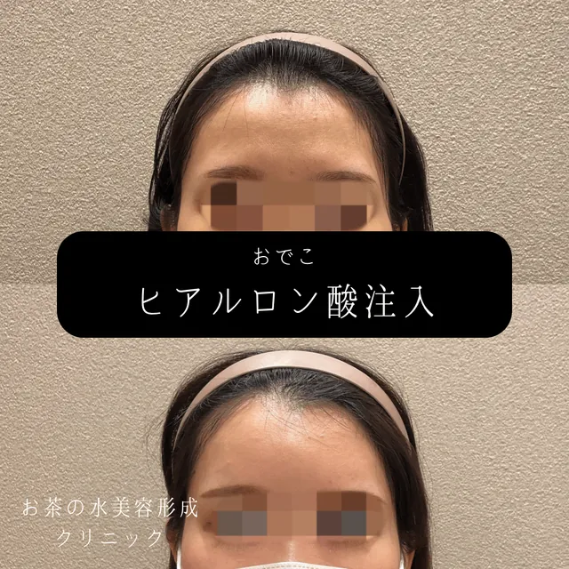 おでこヒアルロン酸注入