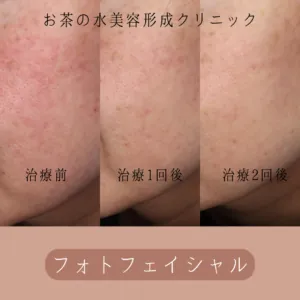 フォトフェイシャル