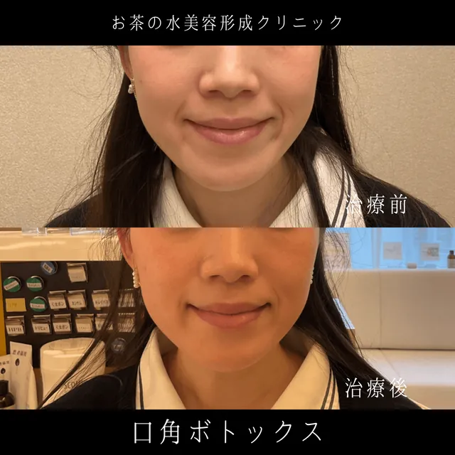 口角ボトックス