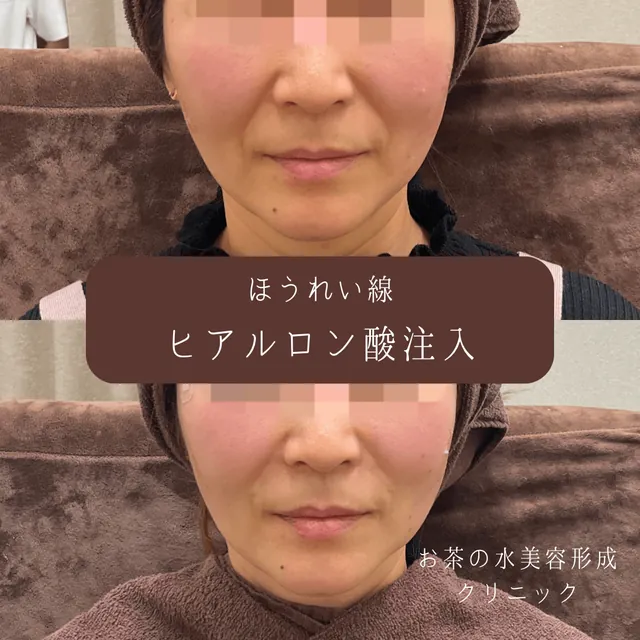 ほうれい線ヒアルロン酸注入