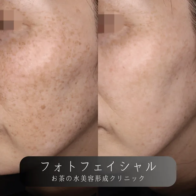 フォトフェイシャル