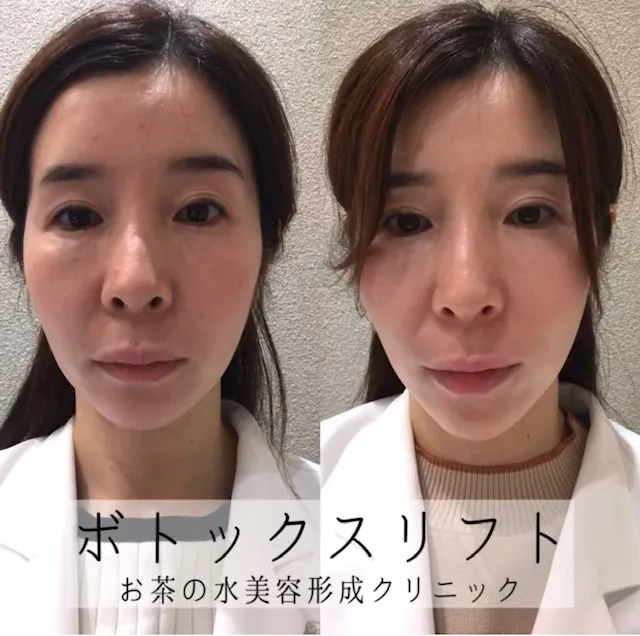ボトックスリフト