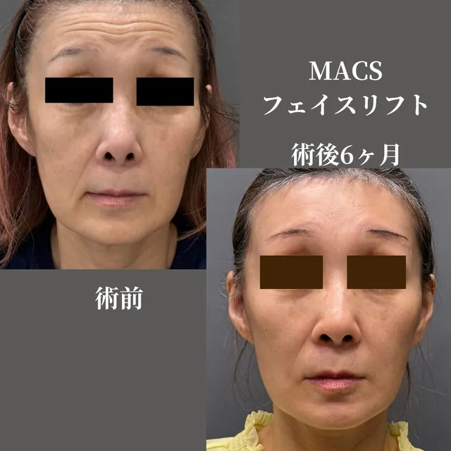 拡大MACSフェイスリフト