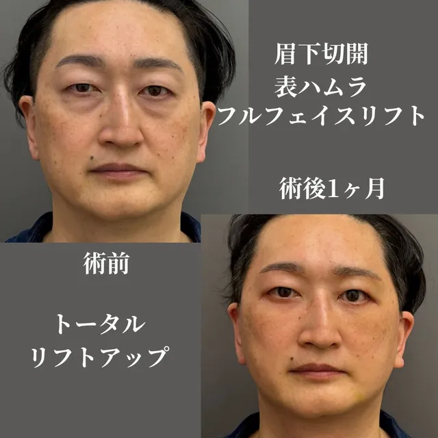 眉下切開+表ハムラ+フルフェイスリフト